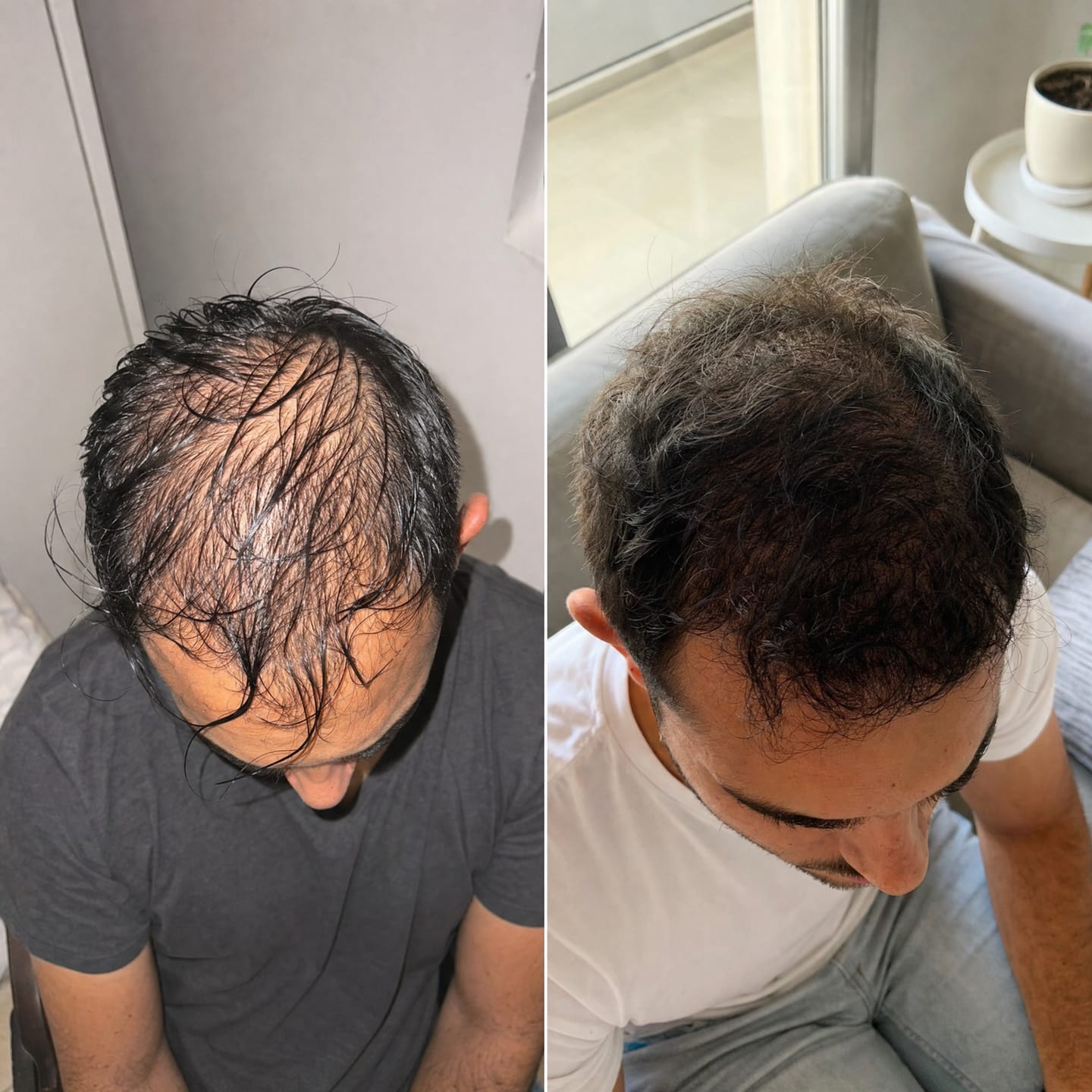 Customer photo review of RootFix™ | ערכה לטיפול בנשירה והתקרחות של השיער