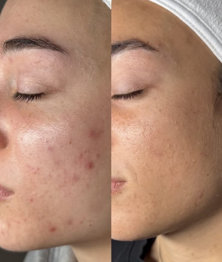 Customer photo review of NovaSculpt Glow — Alta Frecuencia para Piel Radiante y Sin Acné