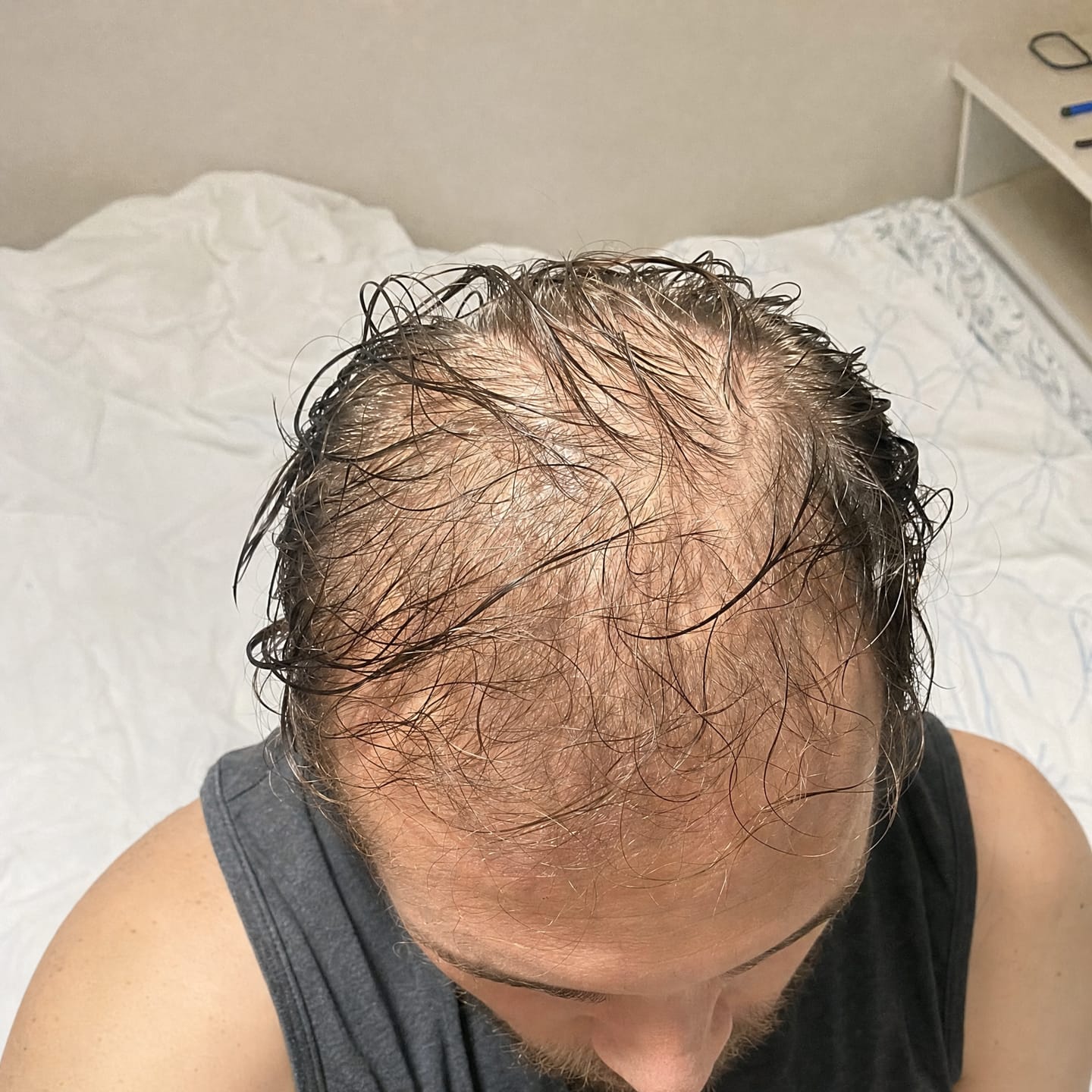 Customer photo review of RootFix™ | ערכה לטיפול בנשירה והתקרחות של השיער