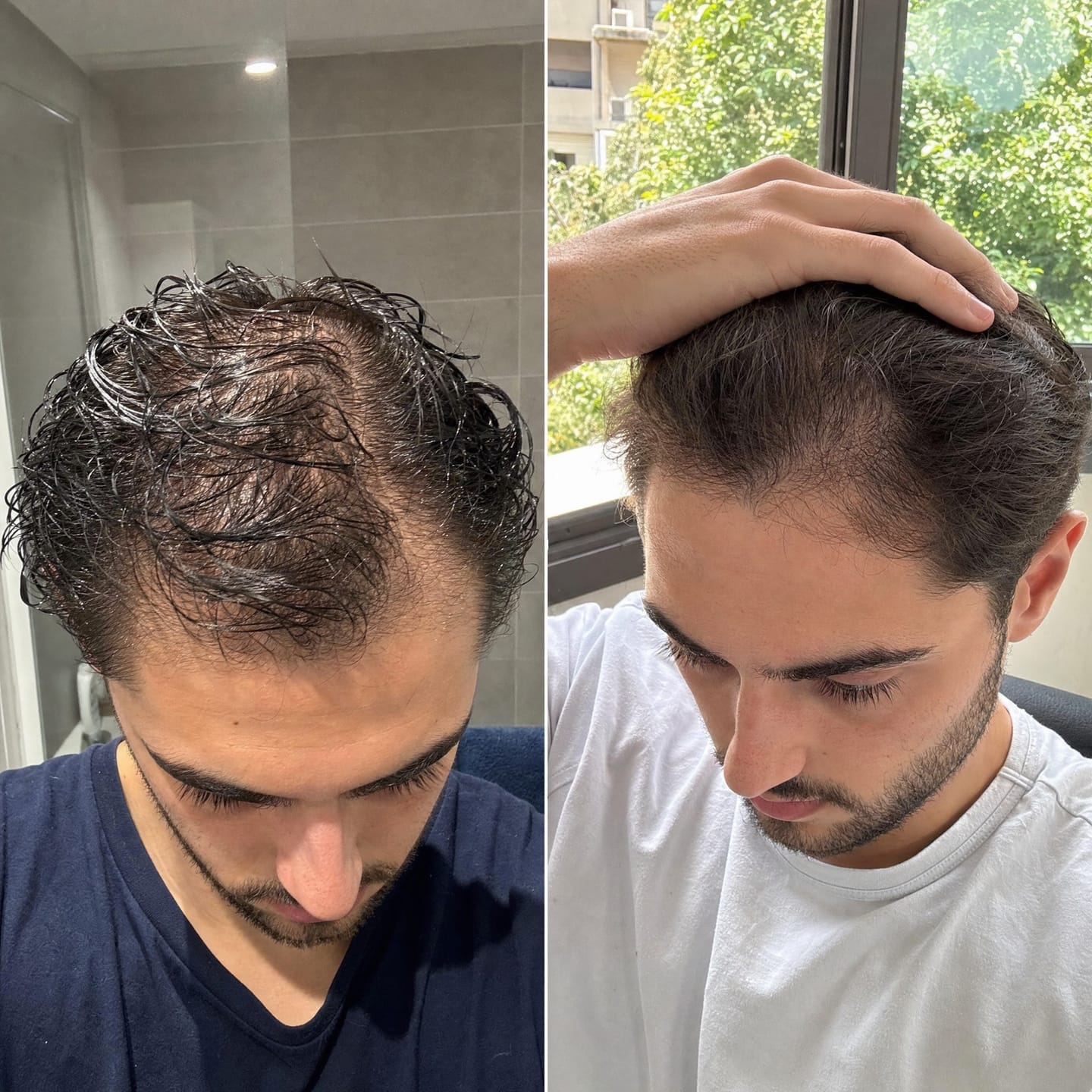 Customer photo review of RootFix™ | ערכה לטיפול בנשירה והתקרחות של השיער