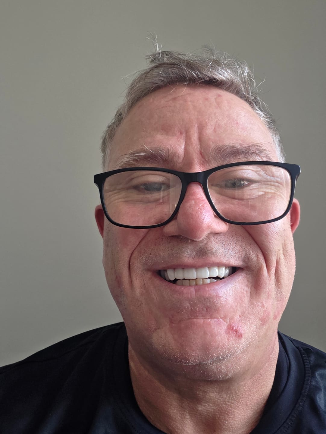 Customer photo review of Click-in Veneers 4.0