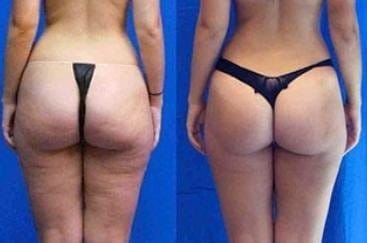 Customer photo review of VELRA™ - Masajeador Rotatorio Anticelulitis.