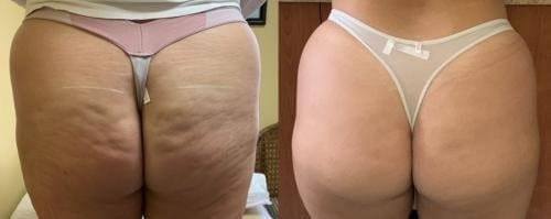Customer photo review of VELRA™ - Masajeador Rotatorio Anticelulitis.