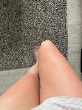 Customer photo review of VELRA™ - Masajeador Rotatorio Anticelulitis.
