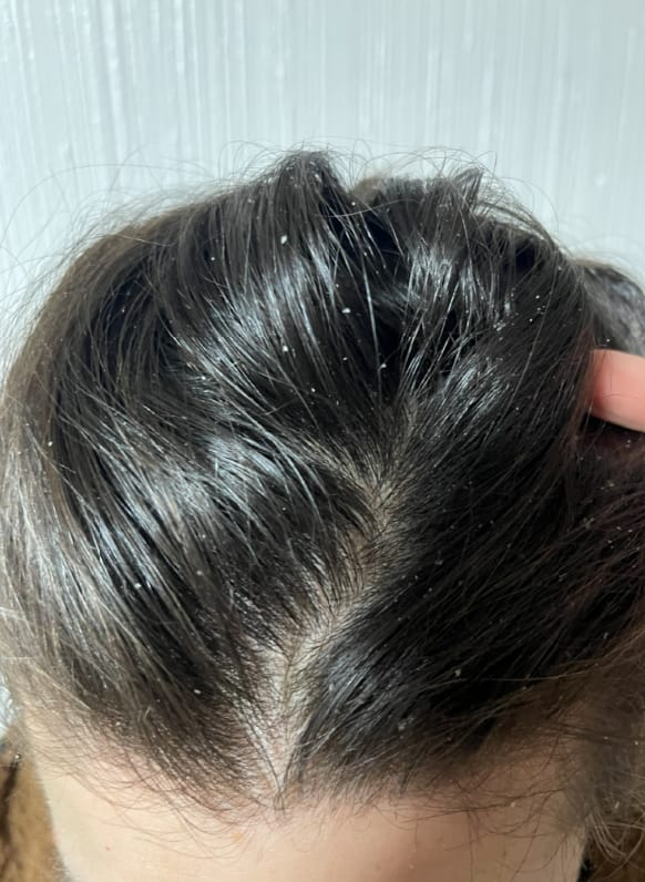 Customer photo review of Shampoo Anticaspa en barra · 70 g (XL)