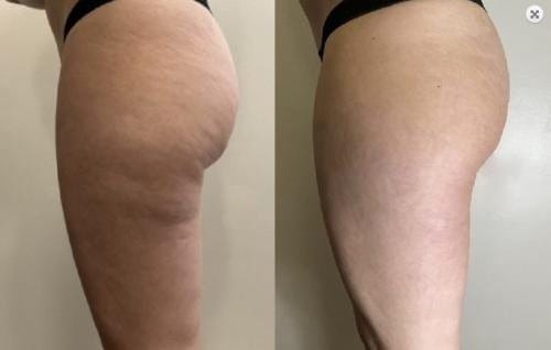Customer photo review of VELRA™ - Masajeador Rotatorio Anticelulitis.