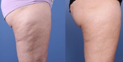 Customer photo review of VELRA™ - Masajeador Rotatorio Anticelulitis.