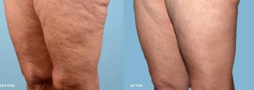 Customer photo review of VELRA™ - Masajeador Rotatorio Anticelulitis.