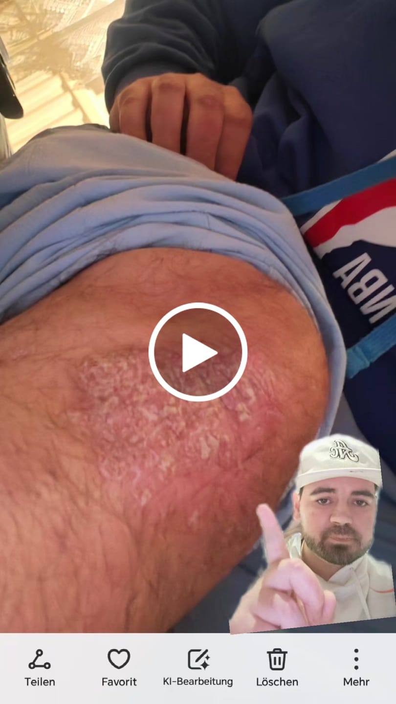 Customer video review of Smiles & Joys Eczema and Psoriasis Herbal Cream