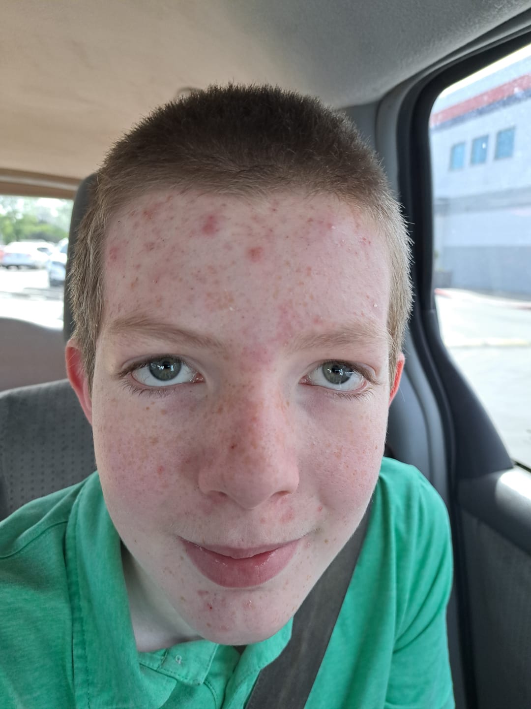 Customer photo review of The Complete System for Acne-Prone Skin