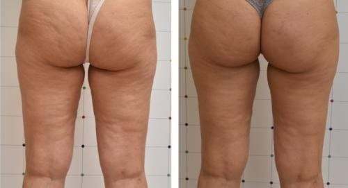 Customer photo review of VELRA™ - Masajeador Rotatorio Anticelulitis.
