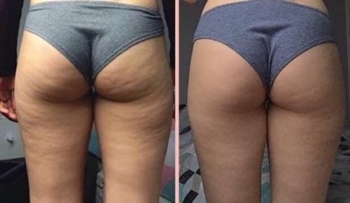 Customer photo review of VELRA™ - Masajeador Rotatorio Anticelulitis.