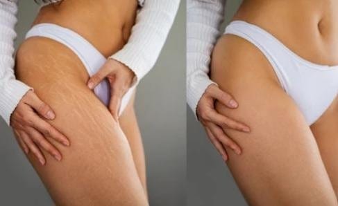 Customer photo review of VELRA™ - Masajeador Rotatorio Anticelulitis.