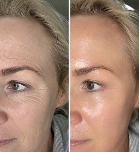 Customer photo review of AUŠRA — Ląstelių atsinaujinimas be adatų
