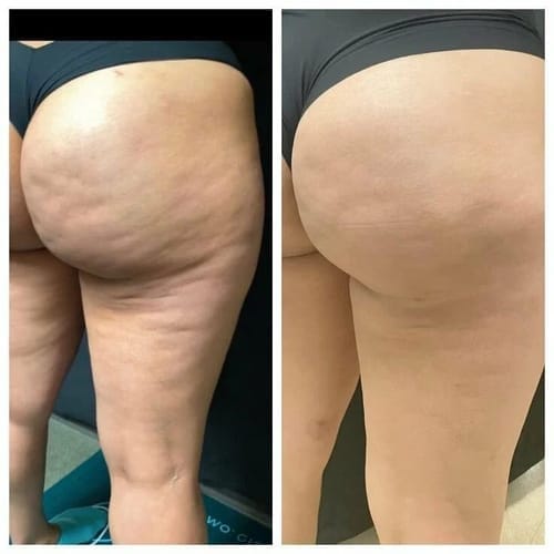 Customer photo review of VELRA™ - Masajeador Rotatorio Anticelulitis.