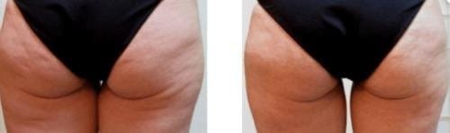 Customer photo review of VELRA™ - Masajeador Rotatorio Anticelulitis.