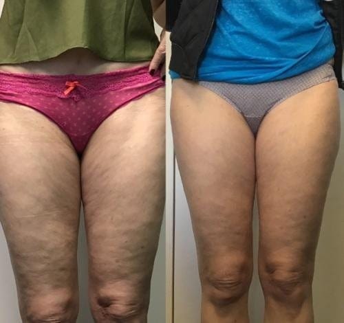Customer photo review of VELRA™ - Masajeador Rotatorio Anticelulitis.