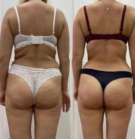 Customer photo review of VELRA™ - Masajeador Rotatorio Anticelulitis.