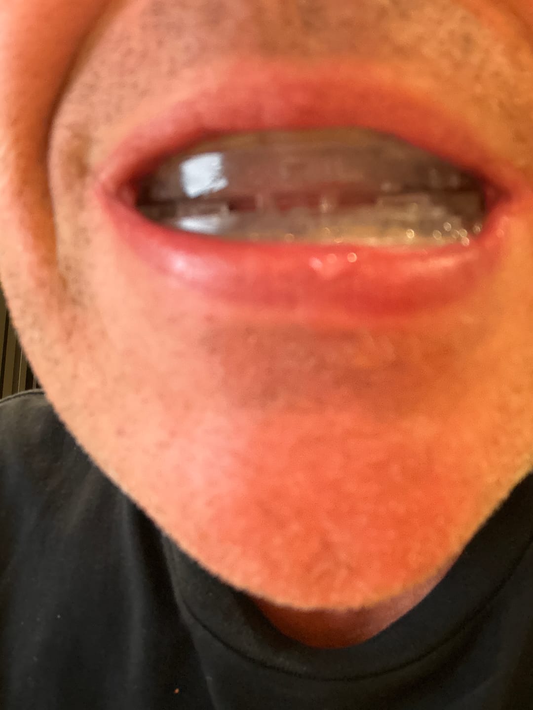 Customer photo review of NoSnore Pro™ Anti-Snoring Mouthpiece
