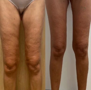 Customer photo review of VELRA™ - Masajeador Rotatorio Anticelulitis.