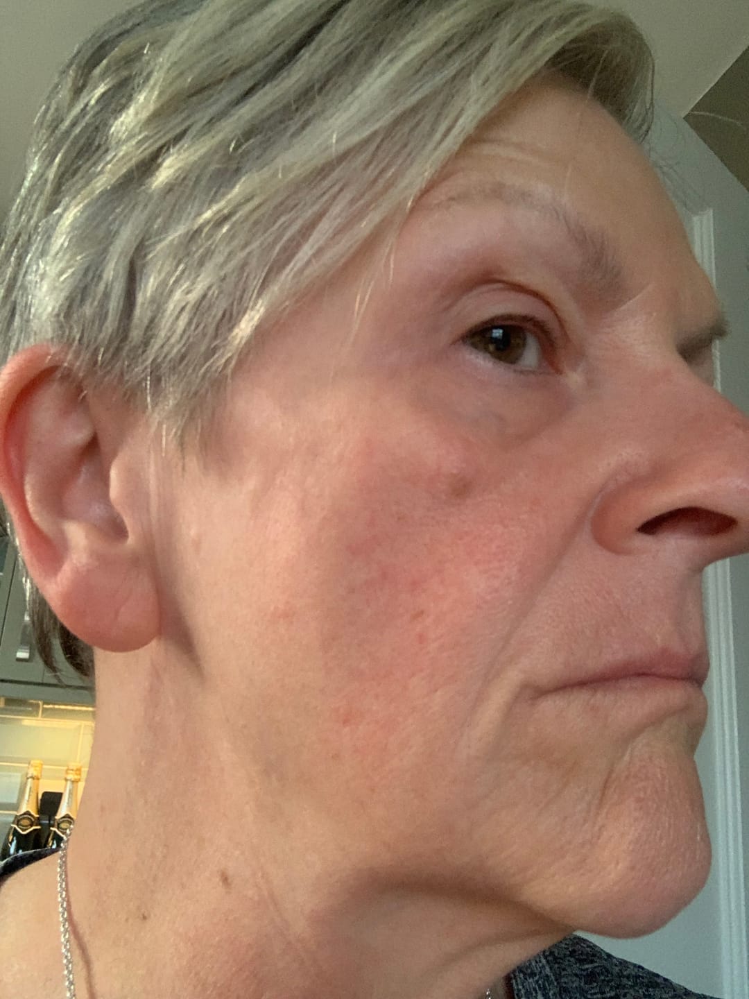 Customer photo review of ZO Redness Relief + Barrier Defense Program For Red, Sensitized Skin