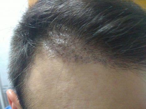 Customer photo review of HairBloom™ Korean Scalp Revival MEN