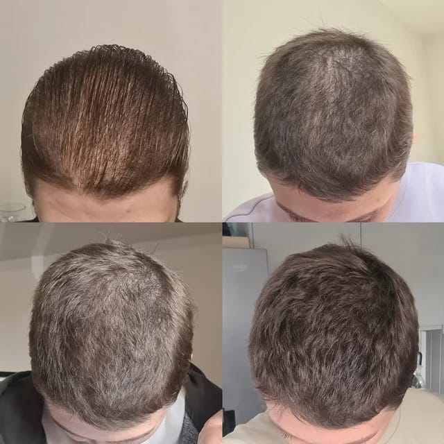 Customer photo review of HairBloom™ Korean Scalp Revival MEN