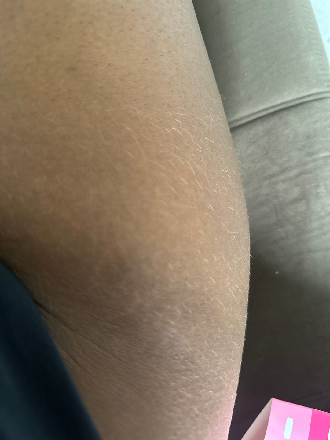 Customer photo review of Creme Antiestrias Regenerador Dérmico