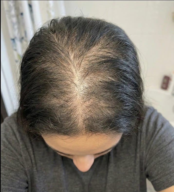 Customer photo review of HairBloom™ Korean Scalp Revival Women