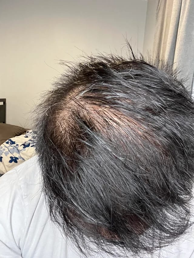 Customer photo review of HairBloom™ Korean Scalp Revival MEN