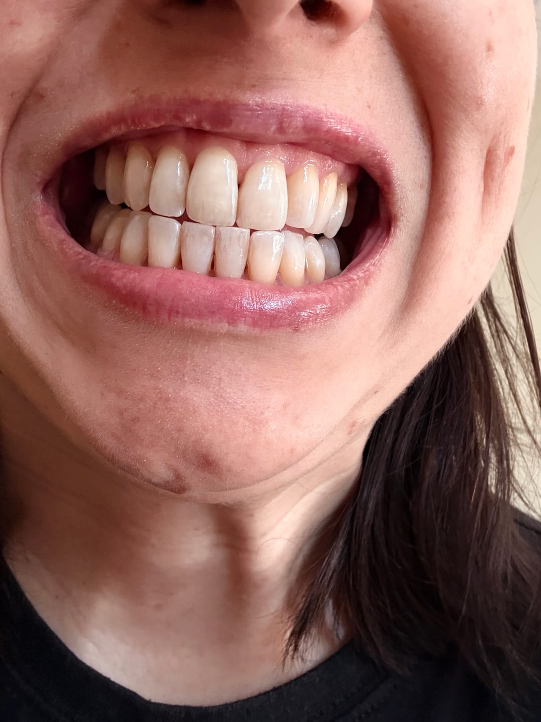 Customer photo review of Pack Ultime : Gel Violet + Bandes Blanchissantes