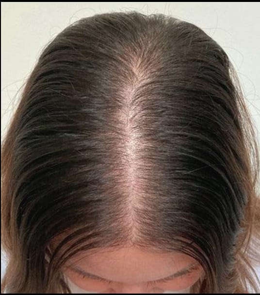 Customer photo review of HairBloom™ Korean Scalp Revival Women