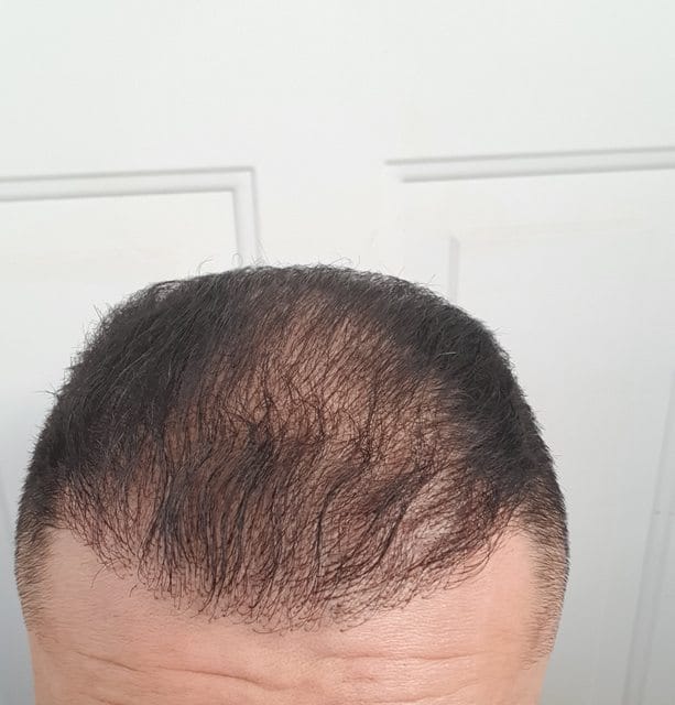 Customer photo review of HairBloom™ Korean Scalp Revival MEN