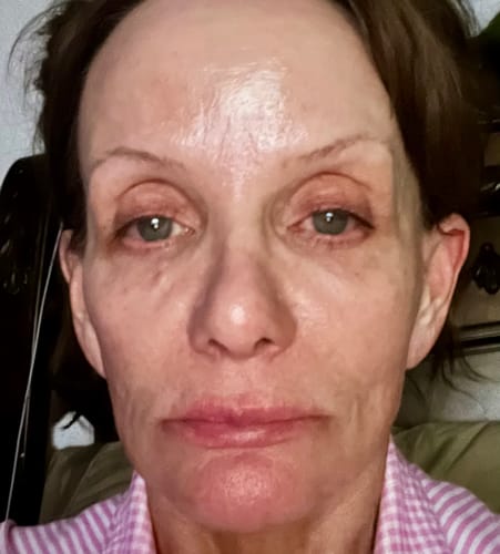 Customer's face after using the Seranova Micro Infusion System, showing firmer skin.