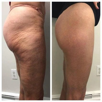 Customer photo review of CurvaLift™  - Licras 3D marca silueta