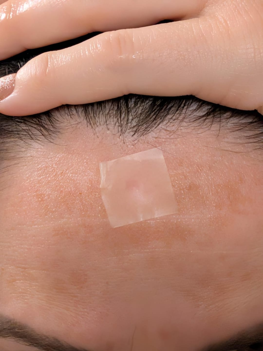 Customer photo review of DermaSeal™ - Parche Anti-Granos en Rollo