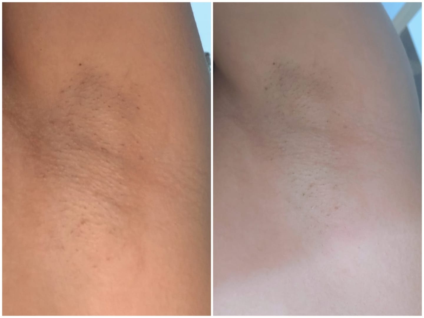 Customer photo review of Creme Clareador de Manchas – Melasma, Axilas, Virilha, Áreas Íntimas, Rosto e Corpo