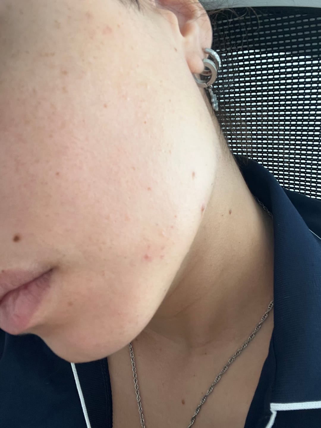 Customer photo review of A CONTROL - ACNÉ HORMONAL & RESISTENCIA A LA INSULINA