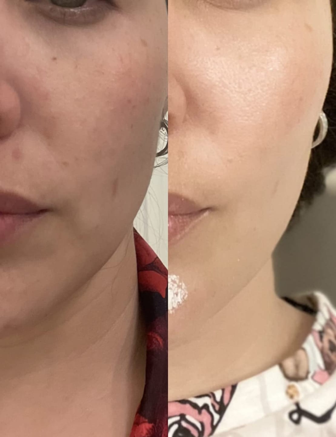Customer photo review of Exosome & Niacinamide Serum for Radiant, Smoother-Looking Skin