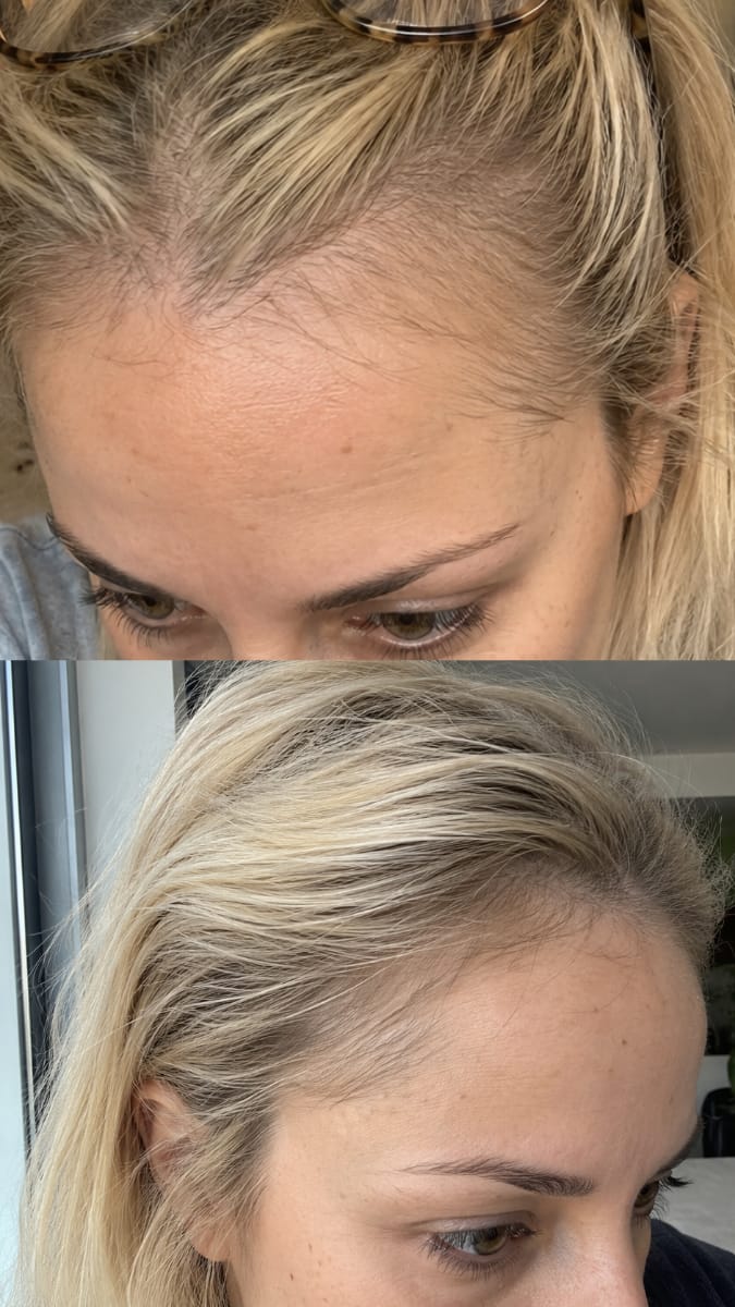 Customer photo review of KosmaHair Sérum | Restaurador Capilar & Entradas