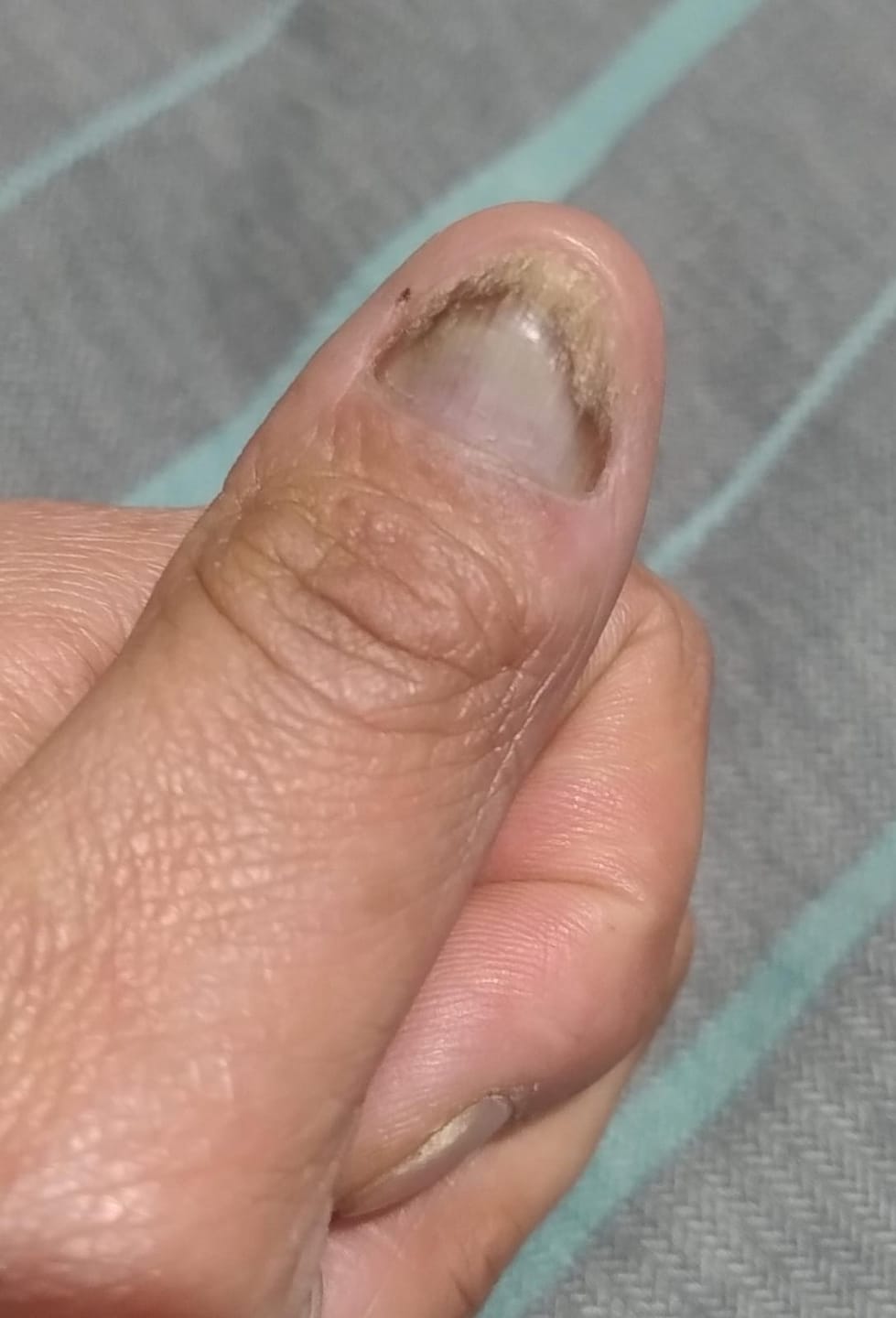 Customer photo review of MyCurePro® · Elimina hongos en pies y manos · 7 días