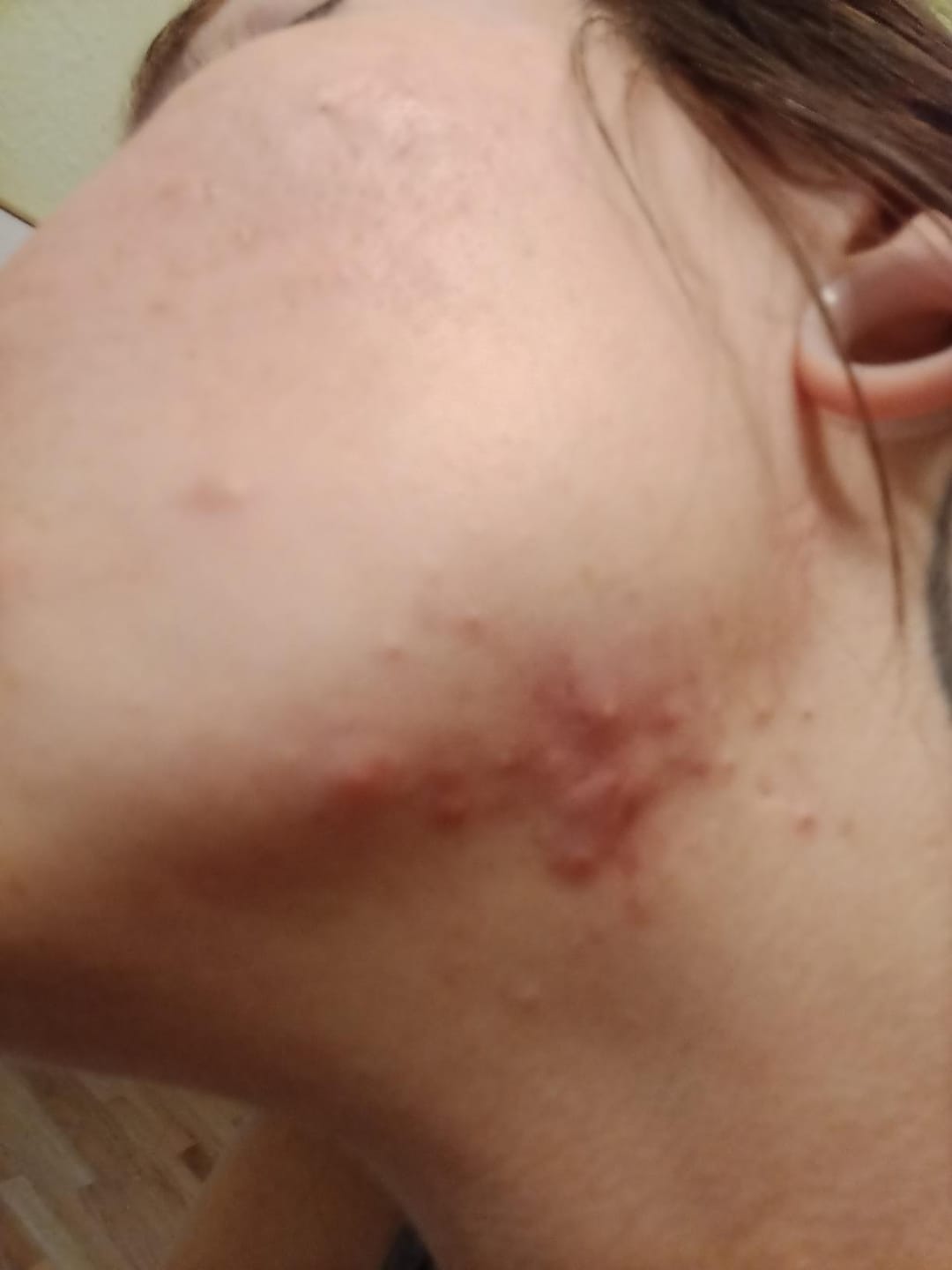 Customer photo review of Exosome & Niacinamide Serum for Radiant, Smoother-Looking Skin
