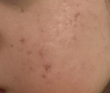 Customer photo review of Exosome & Niacinamide Serum for Radiant, Smoother-Looking Skin
