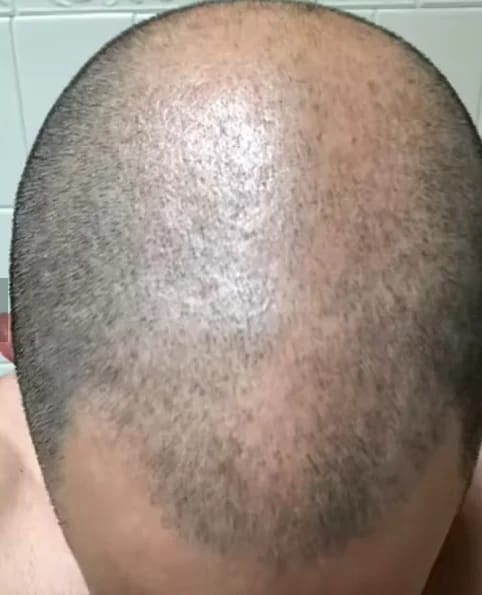 Customer photo review of Kivarea™ Sistema de Regeneración Capilar