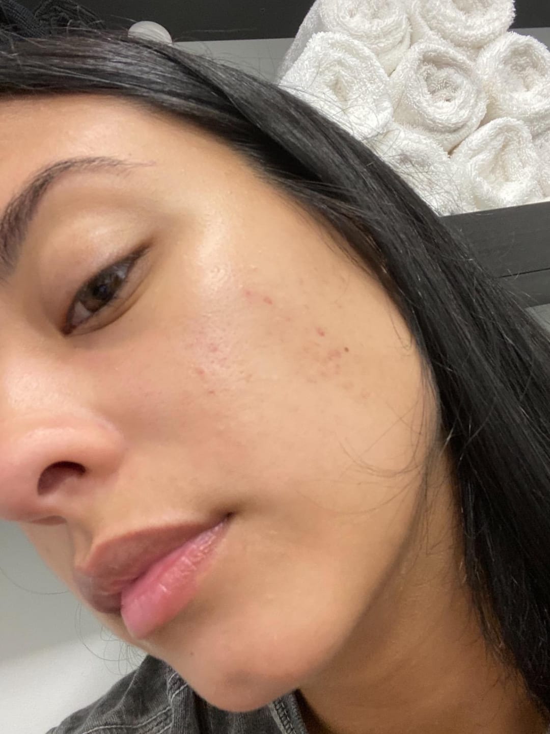 Customer photo review of Exosome & Niacinamide Serum for Radiant, Smoother-Looking Skin