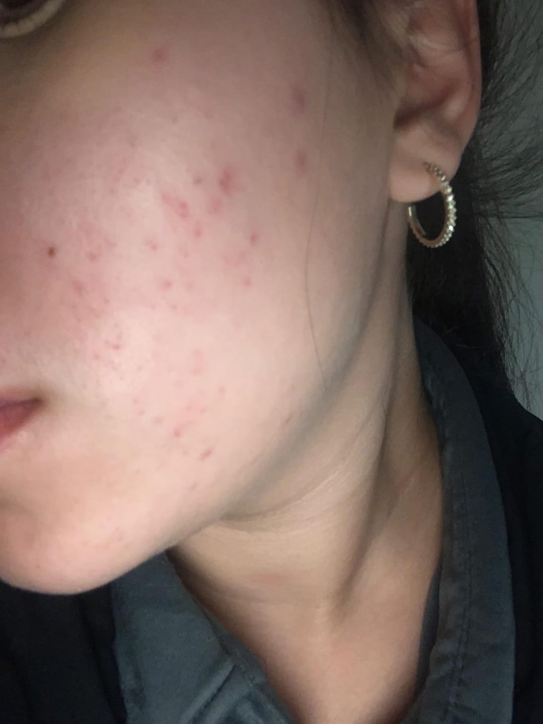 Customer photo review of Exosome & Niacinamide Serum for Radiant, Smoother-Looking Skin