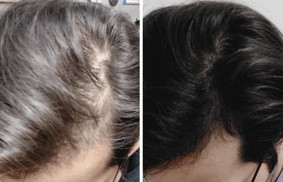 Customer photo review of Kivarea™ Sistema de Regeneración Capilar
