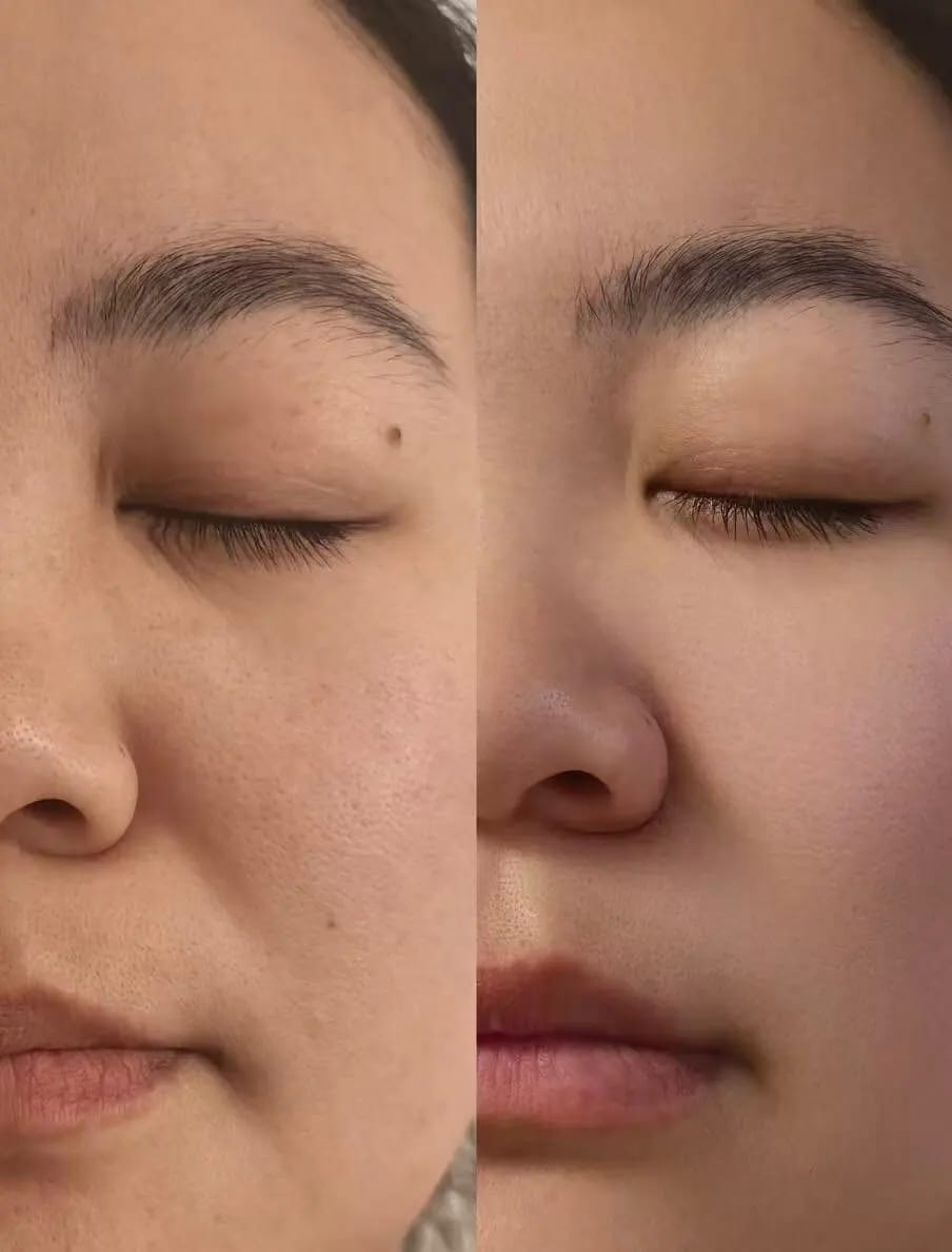 Customer photo review of 2026 New‑Upgraded M6 Facial Skin Management Machine, Hydradermabrasion Deep Cleansing Professional Salon Beauty Skin Care