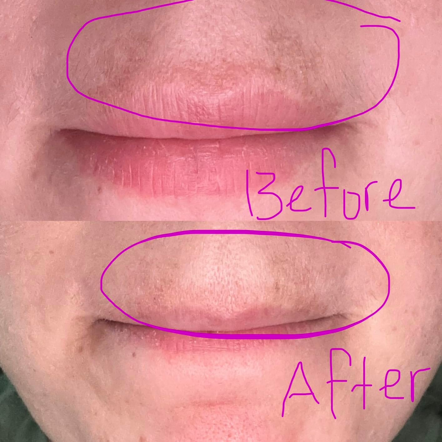 Customer photo review of 1% Kojic Acid Dark Spot Treatment for Brighter, Even-Looking Skin
