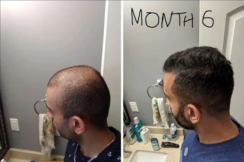 Customer photo review of Kivarea™ Sistema de Regeneración Capilar